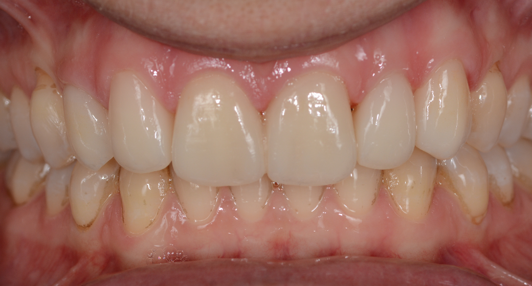 Veneers Patientenfall nachher