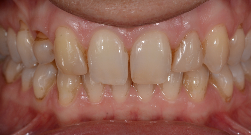 Veneers Patientenfall vorher