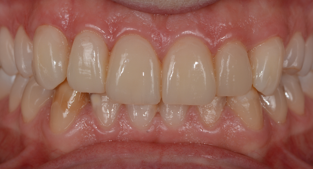 Veneers Patientenfall nachher