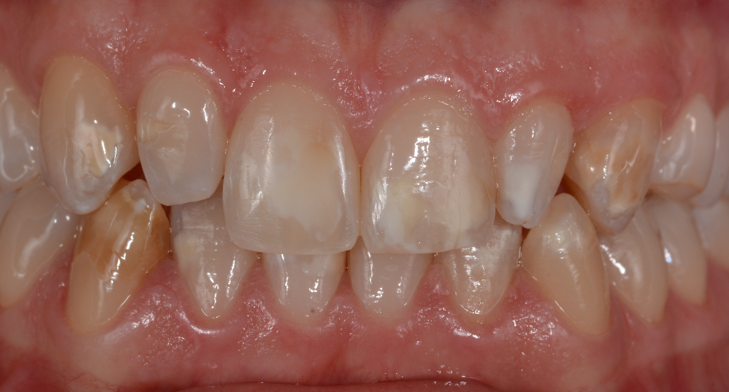 Veneers Patientenfall vorher